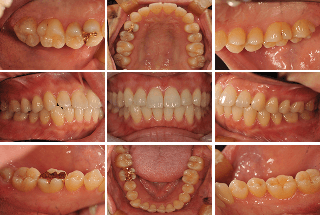 セレックによる審美修復 BEFORE