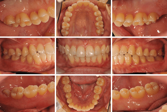 セレックによる審美修復 AFTER