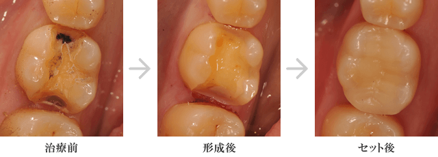 セレックによる審美修復