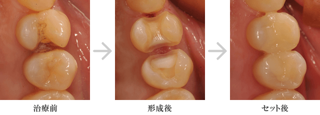 セレックによる審美修復