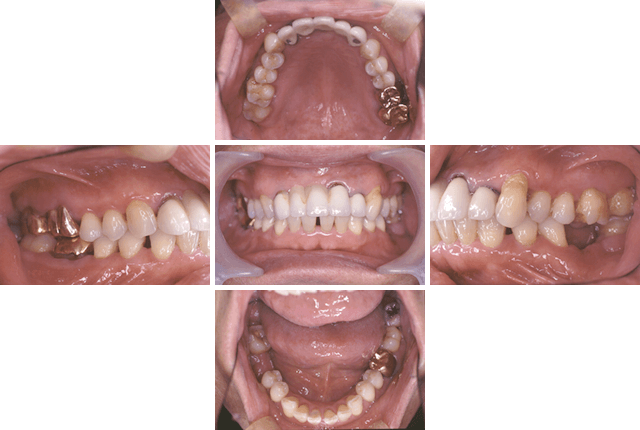 単独歯欠損にインプラント補綴を応用した症例 BEFORE