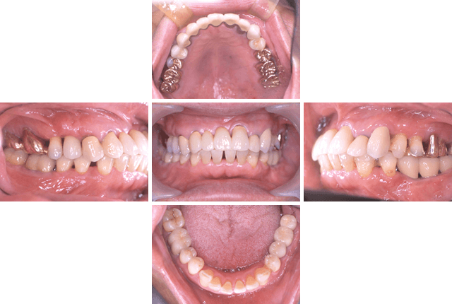 単独歯欠損にインプラント補綴を応用した症例 AFTER