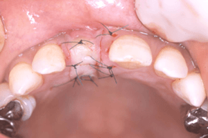 GBR法 (骨の再生移植) 症例02