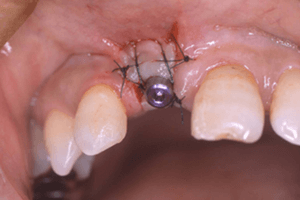 GBR法 (骨の再生移植) 症例03