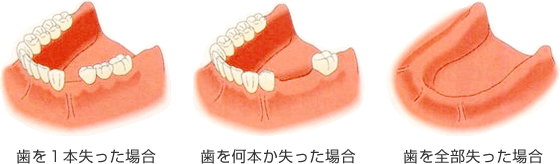歯を失った場合