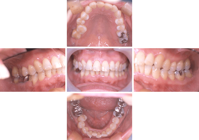 エムドゲインを使用した歯周治療 AFTER