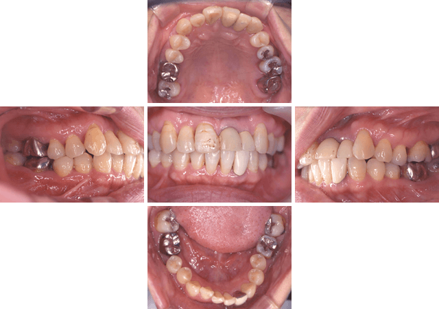 エムドゲインを使用した歯周治療 BEFORE