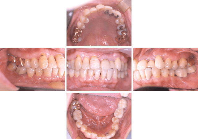 エムドゲインを使用した歯周治療 AFTER