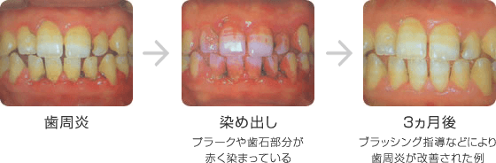 プラークコントロール